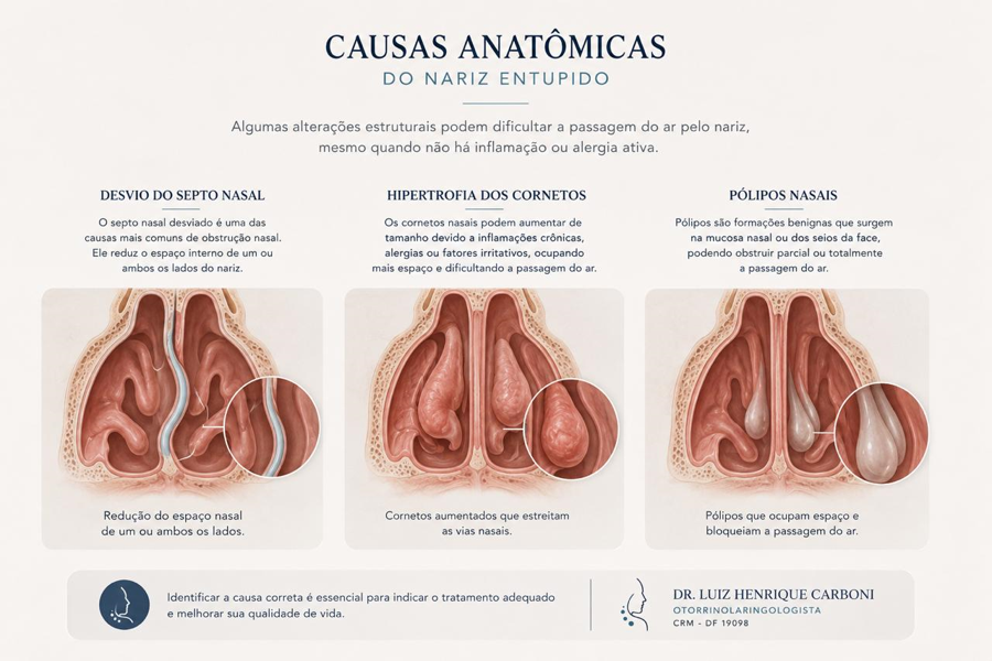 Principais causas anatômicas do nariz entupido, como desvio de septo, hipertrofia dos cornetos e pólipos nasais