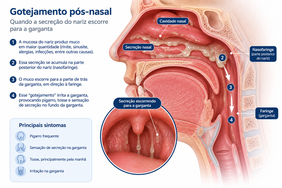 Ilustração mostrando secreção nasal escorrendo para a garganta.