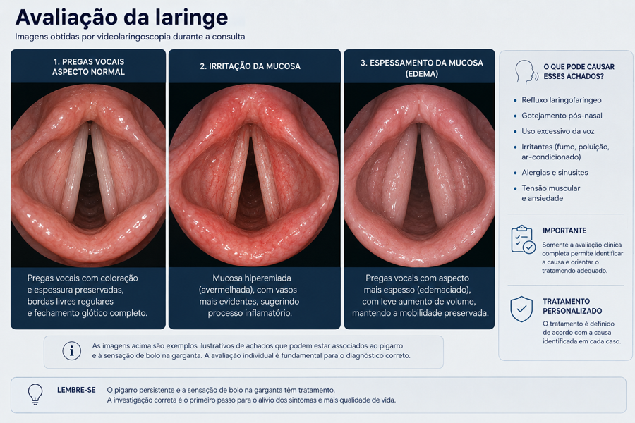 Avaliação da laringe mostrando pregas vocais normais, irritadas e com edema