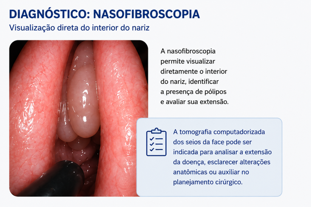 Nasofibroscopia mostrando pólipos nasais no interior do nariz
