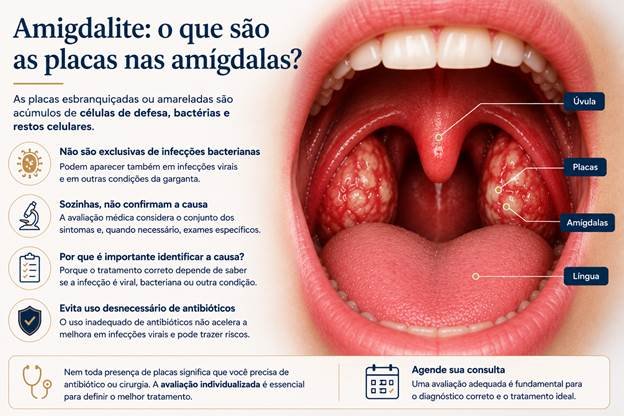 Amígdalas inflamadas com placas esbranquiçadas