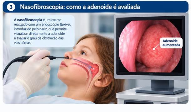 Nasofibroscopia infantil mostrando adenoide aumentada durante a investigação.