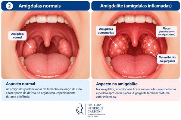 Amigdalite infantil: comparação entre amígdalas normais e amígdalas inflamadas.