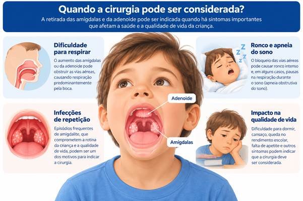 Aumento das amígdalas e da adenoide: sintomas e situações que podem levar à avaliação cirúrgica.