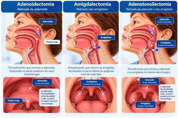 Tipos de cirurgia das amígdalas e da adenoide: amigdalectomia, adenoidectomia e adenotonsilectomia (adenoamigdalectomia)