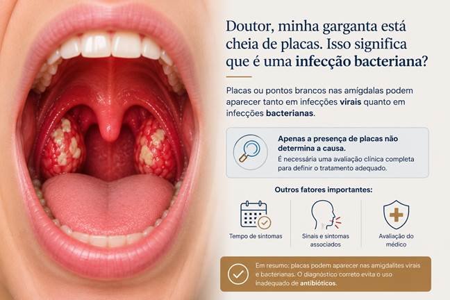 Placas na garganta podem ocorrer em infecções virais e bacterianas